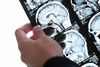 Der findes omkring over 50.000 danskere med Alzheimers sygdom. Hidtil har der ikke været noget, der kunne helbrede sygdommen, og efter syv år med sygdommen dør de fleste patienter.
