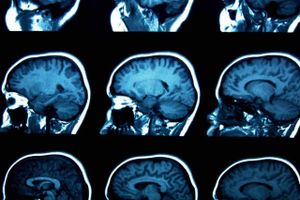 Dagen efter Thanksgiving Day i november 2013 fik Brad Chesivoir scannet sin hjerne, men læserne fandt ingen forklaring på hans voldsomme hovedpine. Ingen neurologiske eksperter så scanningerne, for så ville de formentlig have opdaget en akut subdural blodansamling, der fem uger senere havde udviklet sig livstruende. Arkivfoto