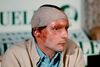 Niki Lauda dukkede stærkt forbrændt op på et pressemøde seks uger efter, at han lå i koma efter sin ulykke på Nürburgring den 1. august 1976. Foto: Hartmut Reeh/picture-alliance/dpa/AP Images