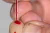 CV19. Covid-19, corona, coronavirus. Antistoftest fra den kinesiske producent Livzon er indkøbt af regionerne for over 60 millioner skattekroner. Testen er usikker og skrottet af de indiske sundhedsmyndigheder. Testen udføres med en dråbe blod. Test.