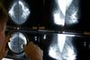Undersøgelse for brystkræft foregår gennem en såkaldt klinisk mammografi. Foto: AP.