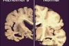 Antallet af personer med demens vil på verdensplan næsten tredobles til 132 millioner i 2050. Over halvdelen af de demensramte lider af Alzheimers. Arkivfoto: AP