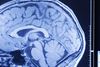 Aarhus Universitet forventer, at den nye uddannelse Neuroscience and Neuroimaging kan udvikle metoder til at blive klogere på demens. Arkivfoto: Mik Eskestad